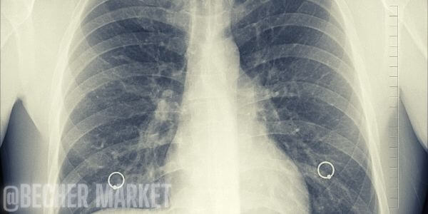 obstrukcni plicni nemoc