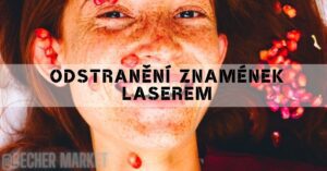 a person’s face showing skin with multiple small, red laser treatment marks, highlighting laserové odstranění znamének.