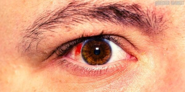 Krvavy flek v oku