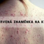 Máte červená znaménka na kůži? Nemáte angiomy? 2025