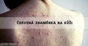 Máte červená znaménka na kůži? Nemáte angiomy? 2026