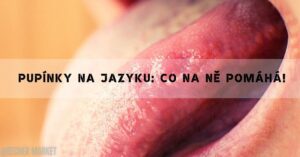 Pupínky a puchýřky na jazyku: Příčiny, Léčba i Prevence!