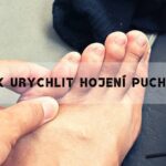 Jak Se Co Nejrychleji Zbavit Puchýře + Nejlepší Babské Rady!