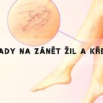 Babské Rady Na Zánět Žil A Křečové Žíly! Přírodní Léčba, Které Funguje!