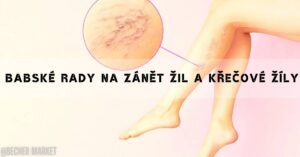 Babské Rady Na Zánět Žil A Křečové Žíly! Přírodní Léčba, Které Funguje!