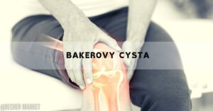 Bakerova Cysta [Léčba, Příčiny, Příznaky & Úleva Od Bolesti]