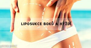 Liposukce Boků a Hýždí: Vše Co Potřebujete Vědět!