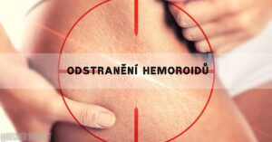 Možnosti Odstranění Hemeroidů [Pomocí operace i bez operace]