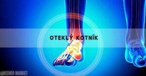 a medical illustration of a swollen ankle with highlighted bones and blood vessels, emphasizing oteklý kotník and potential injury areas.
