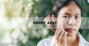 Druhy Akné: Jak Vzniká & Nejlepší Způsoby Prevence & Léčby!