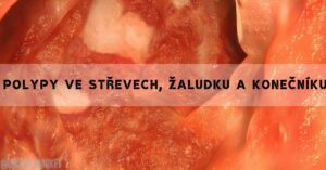 Polypy ve Střevech, Žaludku a Konečníku [Léčba & Diagnóza]