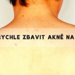 jak se zbavit akné na zádech