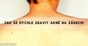 jak se zbavit akné na zádech