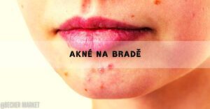 a close-up of acne breakouts on a person’s chin and lower face area, highlighting skin irritation and blemishes.