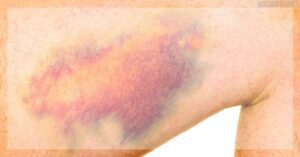 a person’s arm showing extensive bruising with varying shades of purple, red, and yellow indicating damaged blood vessels from injury