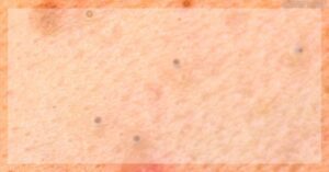 skin with multiple small blackheads and whiteheads scattered across textured facial skin, illustrating clogged pores and comedones.