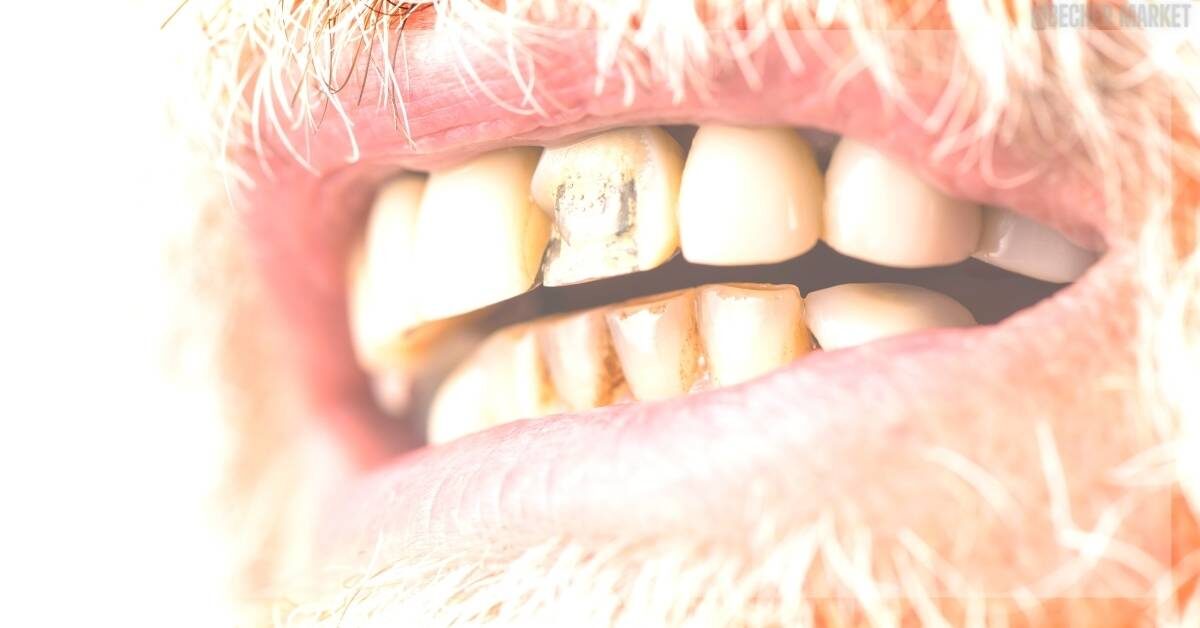 Jak Poznat Zubní Kaz Bez Rentgenu!