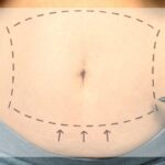 Porovnání 6 Metod Liposukce: Která Je Nejúčinější?
