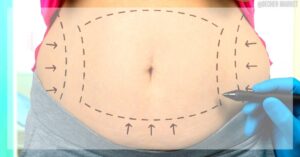a medical illustration showing liposuction target zones on the abdomen with directional arrows indicating fat removal areas.