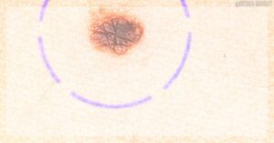 a skin lesion marked with concentric circles for medical evaluation during potential removal or examination, possibly pre-procedure for mateřská znaménka assessment