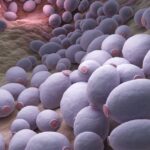 Kandidóza [Candida Albicans]: Příznaky, Léčba & Doporučená Dieta