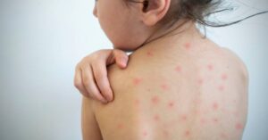 Plané Neštovice: Infekčnost, Příznaky & Léčba!
