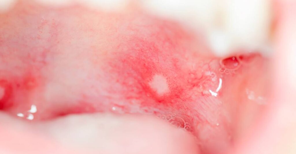 Kvasinky v ústech: Příčiny a způsoby léčby