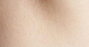 Varování: Miniaturní Červené Tečky Na Kůži Nepodceňujte!