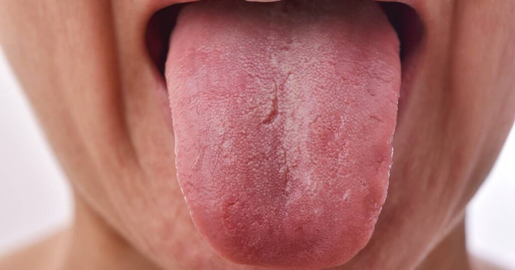 Bílý povlak na jazyku: Příčiny a léčba