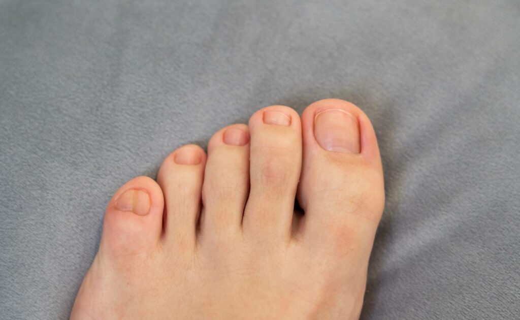 Jak dlouho bolí naražený prst na noze
