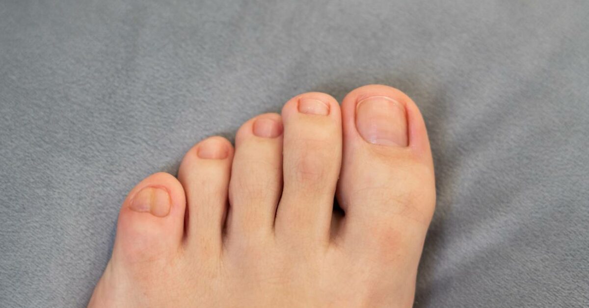 Jak dlouho bolí naražený prst na noze