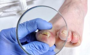 Jak poznat plíseň nehtů od ostatních problémů s nehty: 5 Pířznaků, ne které si musíte dát pozor