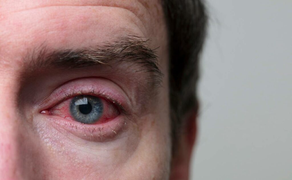 cervene oci priznak alergie
