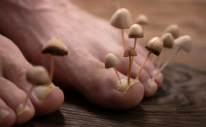 Plíseň nehtů: Zbavte se jí za 1 týden je to snadné