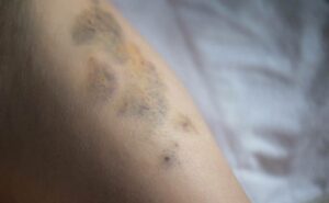 6 Rad jak se co nejrychleji zbavit modřiny na stehnech